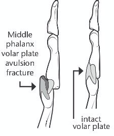 protocol plate|volar plate protocol.
